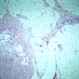 Orbital Fat Invasion, melanoma.